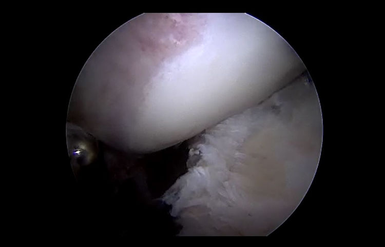 An image shot arthroscopically of significant CAM impingement