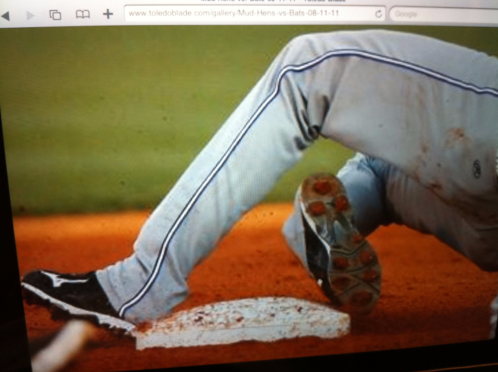 Ankle Fracture (Broken Ankle) Arthroscopy Surgery South Florida