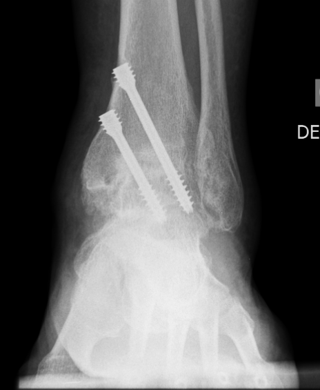 Ankle arthroscopy: ankle fusion postop