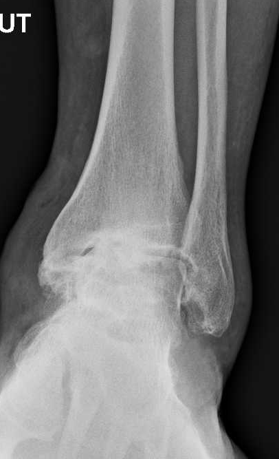Ankle arthroscopy: ankle fusion preop