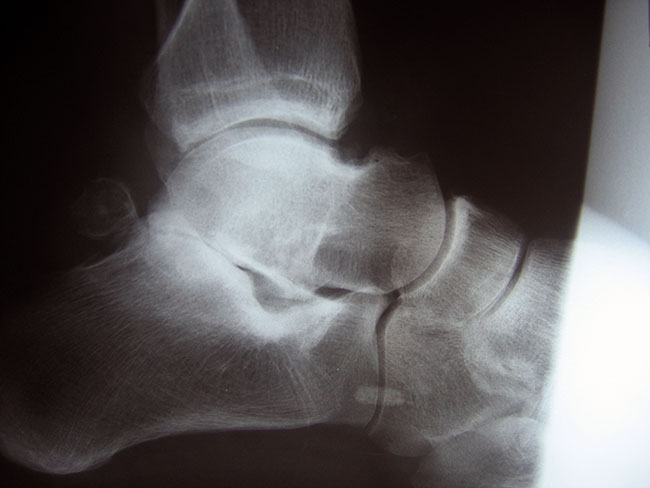 Subtalar arthritis on X-ray treated with arthroscopic subtalar fusion