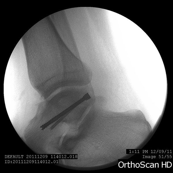Talus (ankle) fracture
