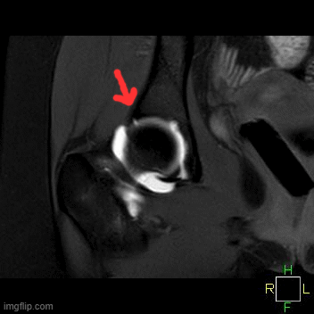Labral tear coronal view with arrow