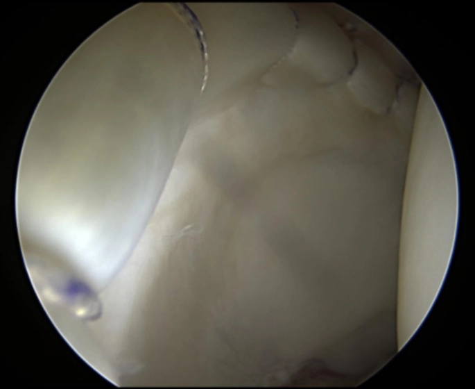 labral repair with healthy, robust tissue