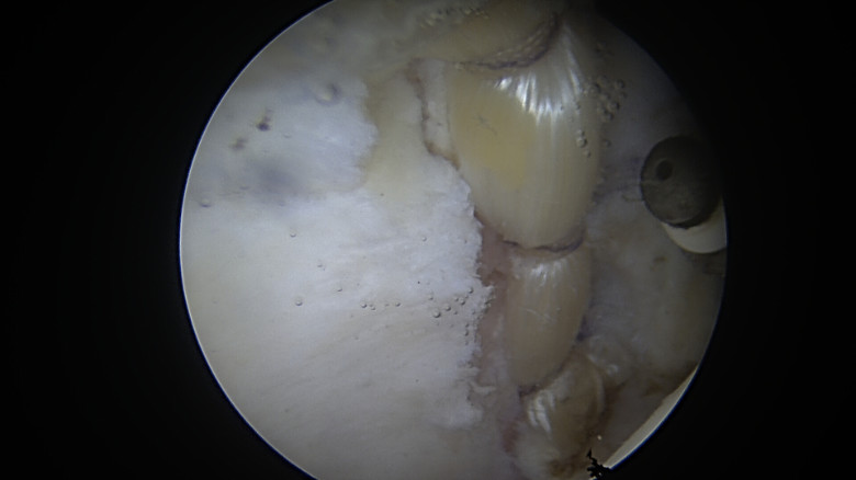 Fascia lata allograft in labral reconstruction of hip in an athletic 29-year-old male