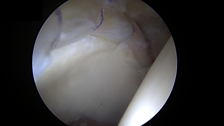 hip labrum repair four circumferential sutures