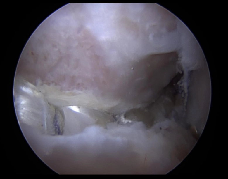 Labral reconstruction as a revision surgery