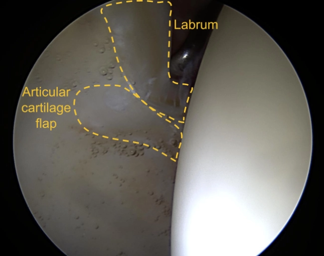 A labral tear with an articular cartilage flap - all highlighted with graphics and text overlays