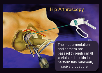 Visual depiction of hip arthroscopy