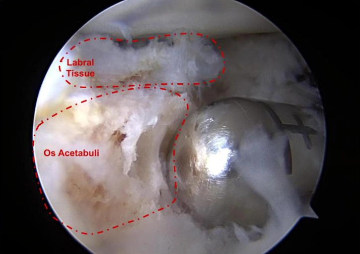 A patient's os acetabuli with too little labral tissue