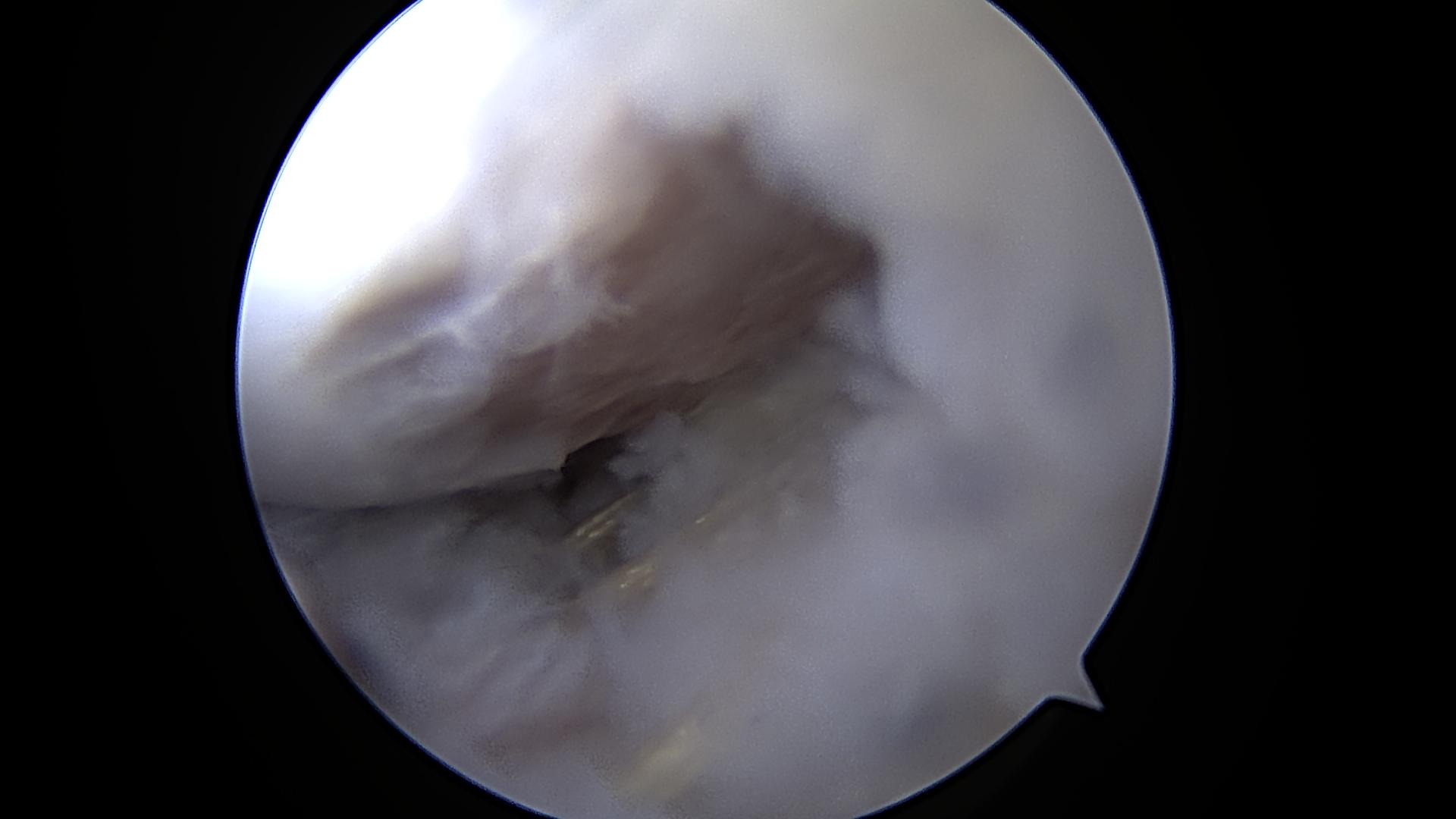 Capsular plication for hip instability