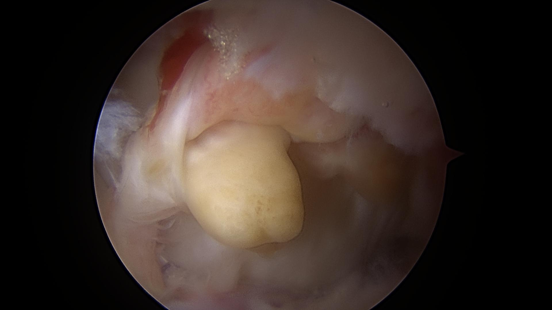 A nodule of PVNS which was removed via a hip arthroscopy
