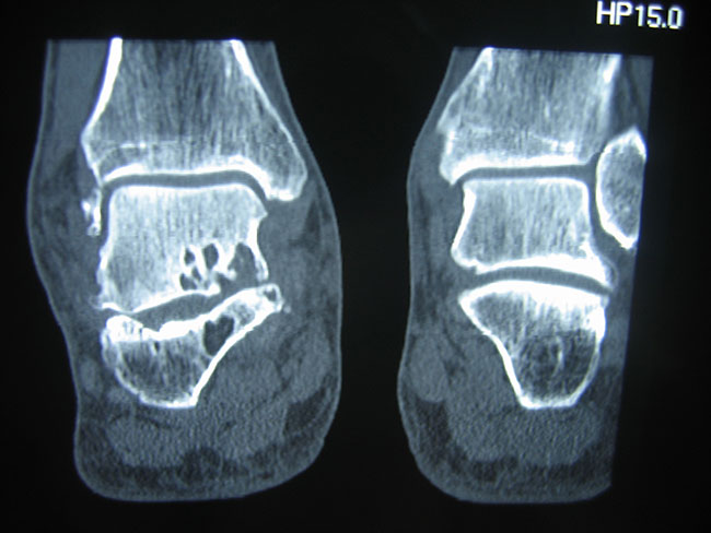 Foot arthritis of subtalar joint on CT-scan treated with arthroscopic subtalar fusion