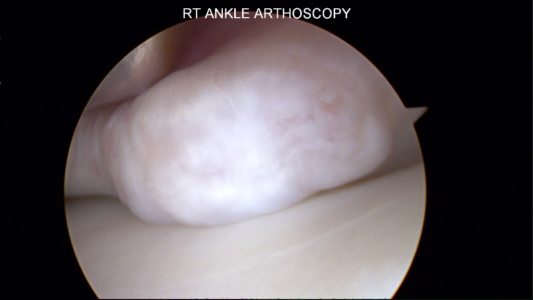 Anterior ankle impingement from a tibial exostosis (spur) as seen arthroscopically