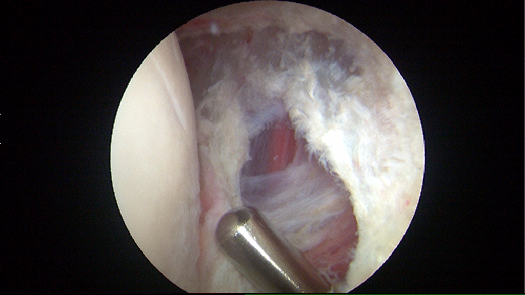 Following removal of the diseased synovium during hip arthroscopy, the joint capsule remains intact.