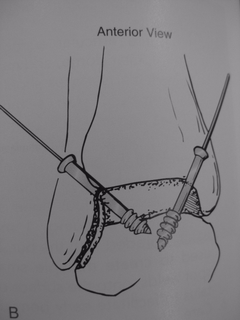 Diagram of screw placement for arthroscopic ankle fusion