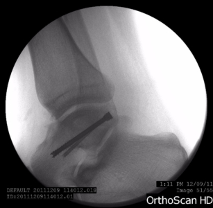 Fracture fixation with arthroscopic assistance