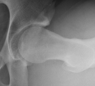 CAM type of Femoroacetabular Impingement before treatment. Note the flattened top surface of the head of the femur, which does not have a normal rounded contour.