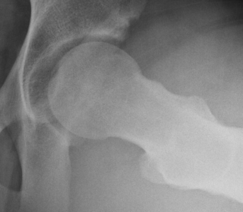 CAM type of Femoroacetabular Impingement after arthroscopic treatment.  The femoral head and neck junction has been reshaped.