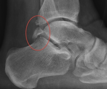 This variant of posterior impingement is likely a fracture through a trigonal process or a separation through an os trigonum.  This patient had severe, episodic pain which was treated effectively with a posterior hindfoot arthroscopic resection.