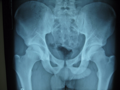 Hip femoroacetabular impingement (FAI) and os acetabuli AP View