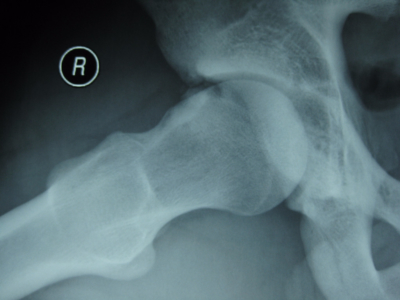 X-ray of Hip femoroacetabular impingement (FAI) and os acetabuli lateral view