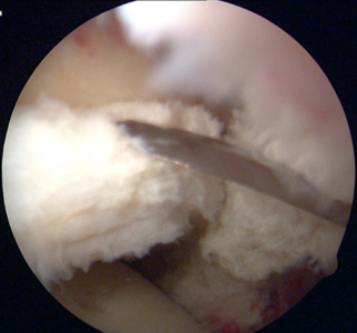 Example of labrum repair: Hip labral takedown for rim trimming prior to repair