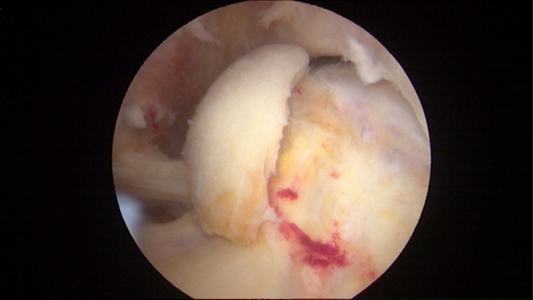 Loose body of articular cartilage in a young patient with acetabular rim cartilage injury and Femoroacetabular Impingement (FAI). This was resected at the time of hip arthroscopy.