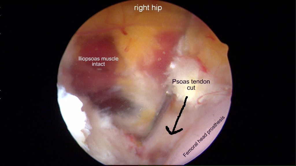 Psoas release in a patient with persistent pain after hip replacement