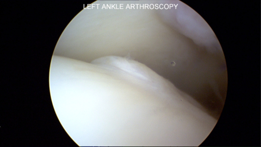 Slight elevation of articular cartilage on talus dome.  This fragment was not attached to the surrounding cartilage but not to the underlying bone onto which it is normally attached