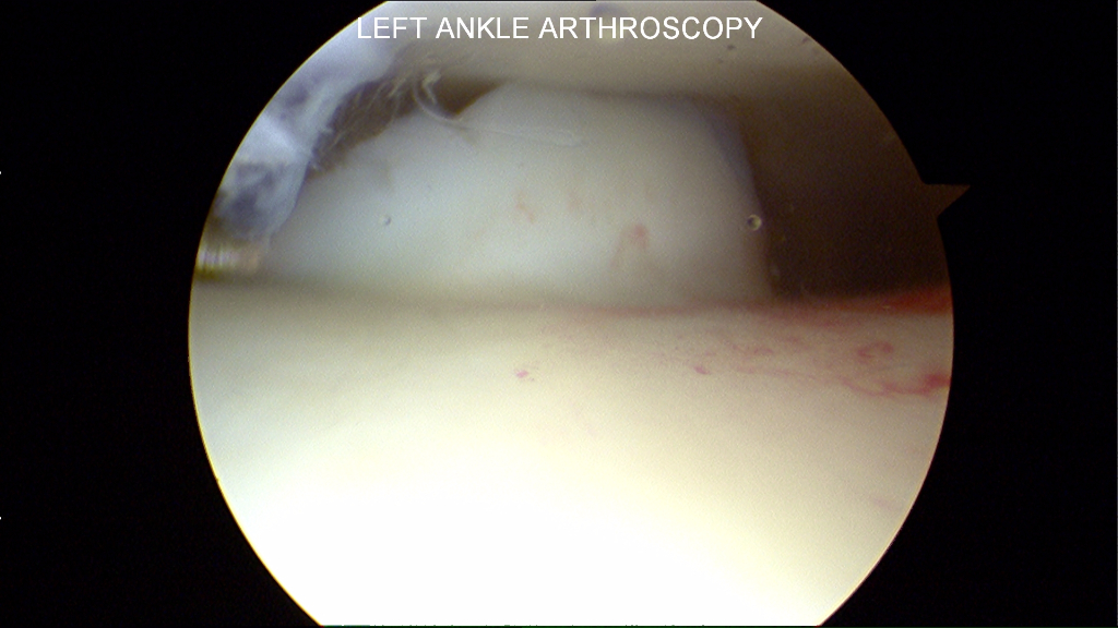 A probe is used to elevate an unstable articular cartilage fragment on the talar dome
