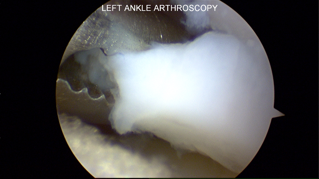Using a grasper to remove a loose fragment of cartilage from the ankle joint