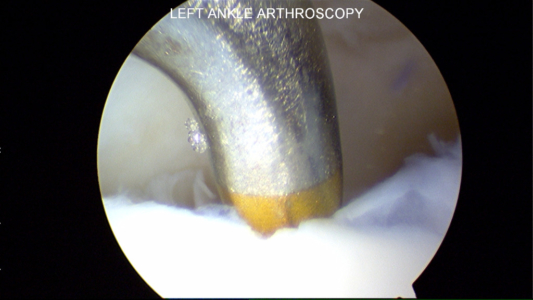Microfracture awl used to perform the microfracture technique.  Multiple holes are placed into the cartilage defect to stimulate cartilage healing.