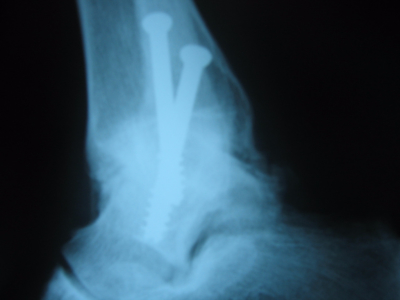 X-ray AP view of ankle fusion after arthroscopic procedure