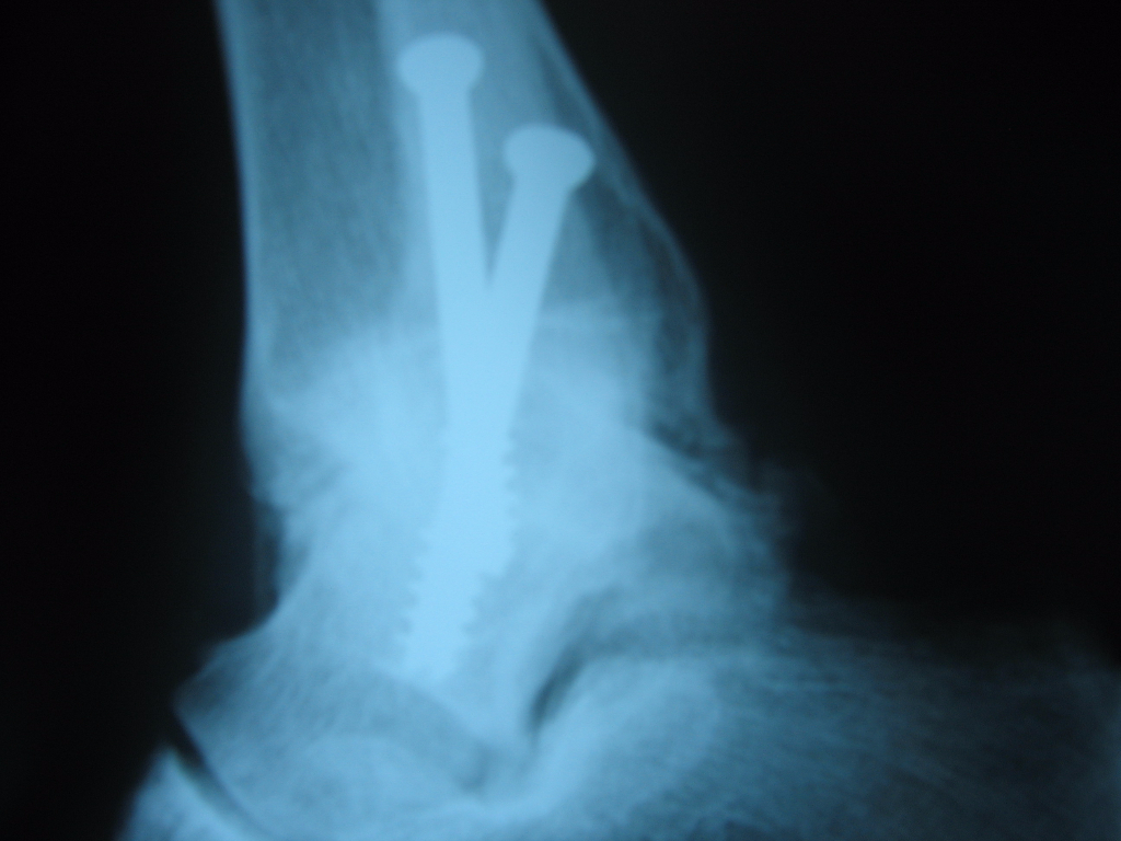 Ankle Arthritis | Ankle Arthroscopy | Dominic Carreira, MD | Atlanta