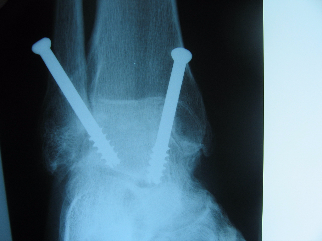 X-ray Lateral view of healed ankle fusion after arthroscopic procedure