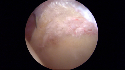 Irreperable labrum with extensive degeneration and calcification