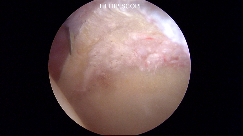 Irreperable labrum with extensive degeneration and calcification