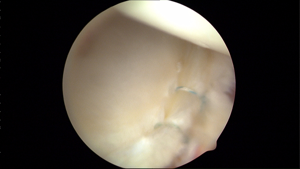 Example of repair of more posterior aspect of joint