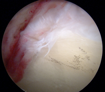 Labral tear and degeneration