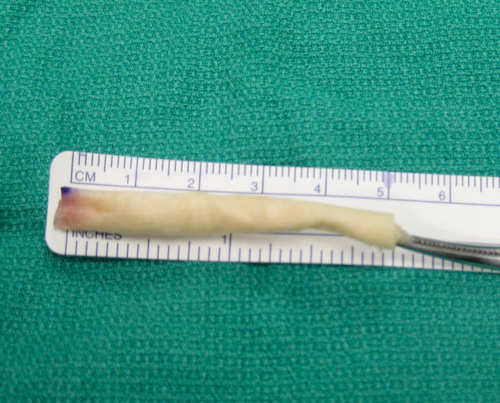 Labrum allograft tissue for hip reconstruction