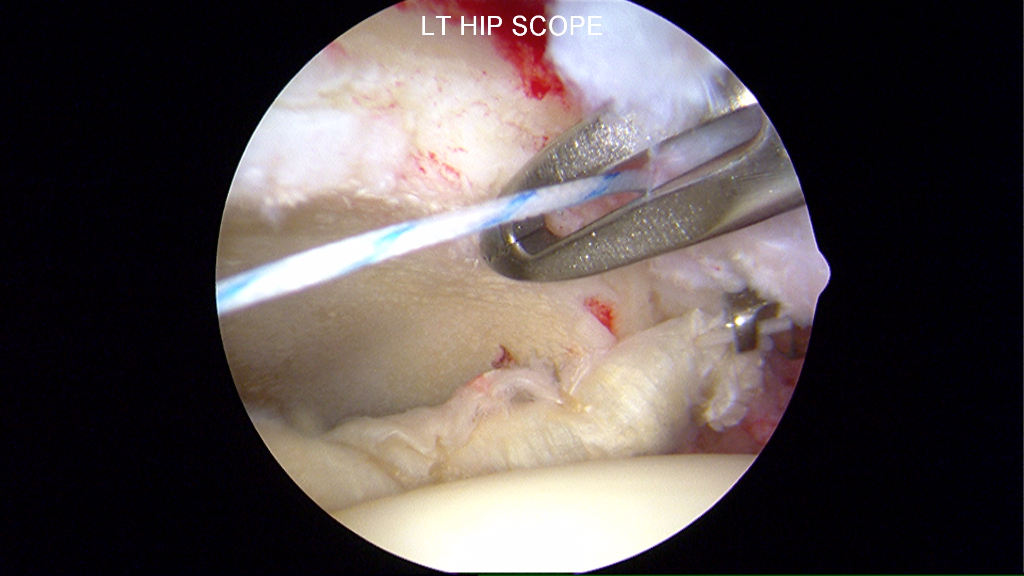 Labrum anchored far anteriorly and posteriorly