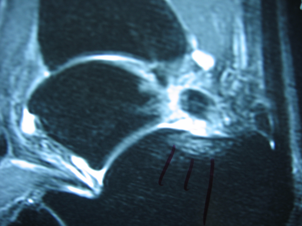 MRI of os trigonum causing posterior impingement