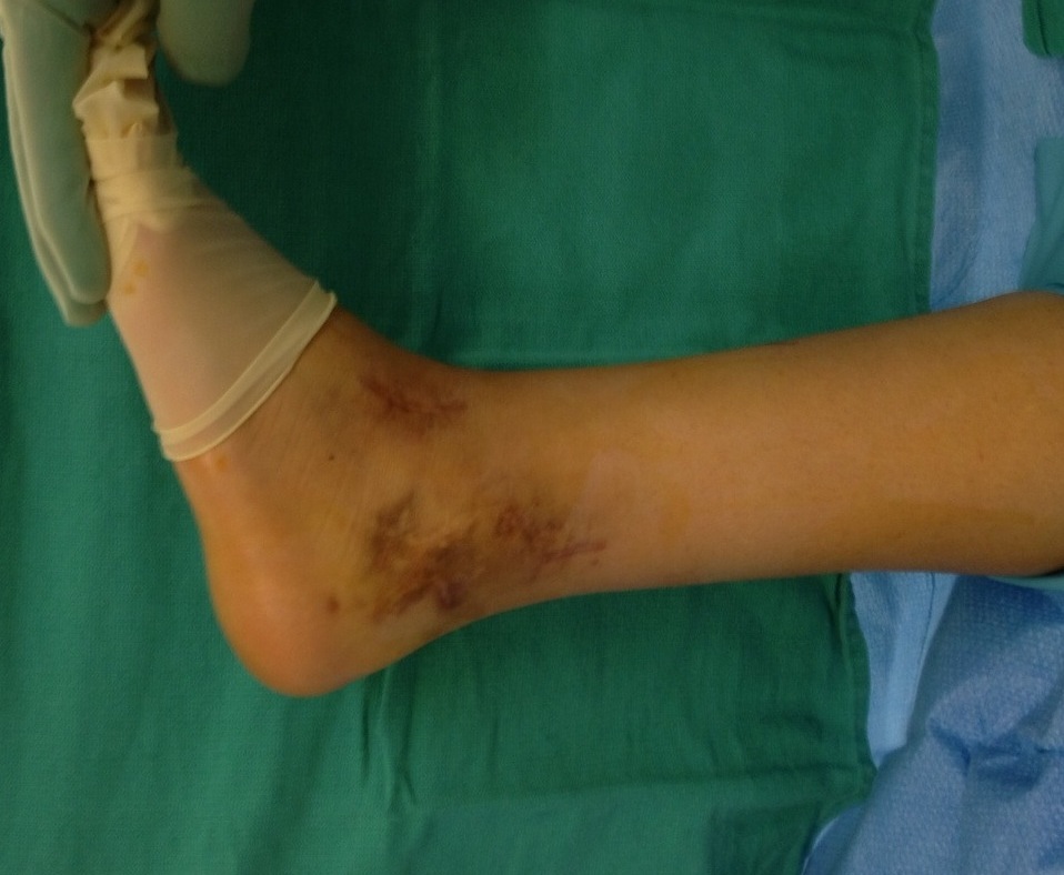 Maximimum ankle dorsiflexion range of motion before arthroscopic release of scarring