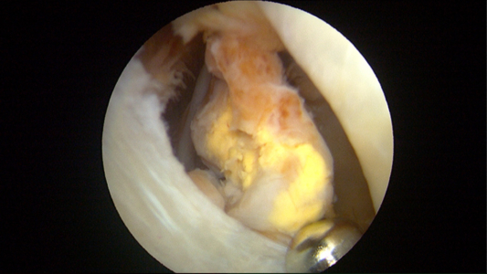 Nodule of diseased PVNS which was removed during hip arthroscop