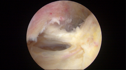 Diseased synovium in the peripheral compartment of the hip