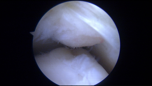 Posterior ankle impingement and OCD: Overhang of soft tissue on the top of the joint created impingement on the talar dome.  This injury was noted in the posterior aspect of the joint and was accessed and treated with a posterior ankle arthroscopy in the prone position.