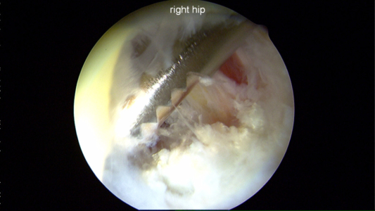 Psoas release for internal snapping of the hip.  To the right of the shaver, the fibers of the psoas tendon are seen.  This procedure was performed from the central compartment of the hip joint.
