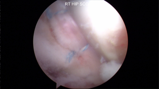Re-creation of suction seal after labral repair during hip arthroscopy.  The seal between the femoral head and the labrum is reestablished.  This picture is taken from the peripheral compartment.