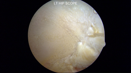 Restoring labral continuity: Labrum treated with electrocautery at the time of debridment.  This tissue was replaced at the time of labral reconstruction